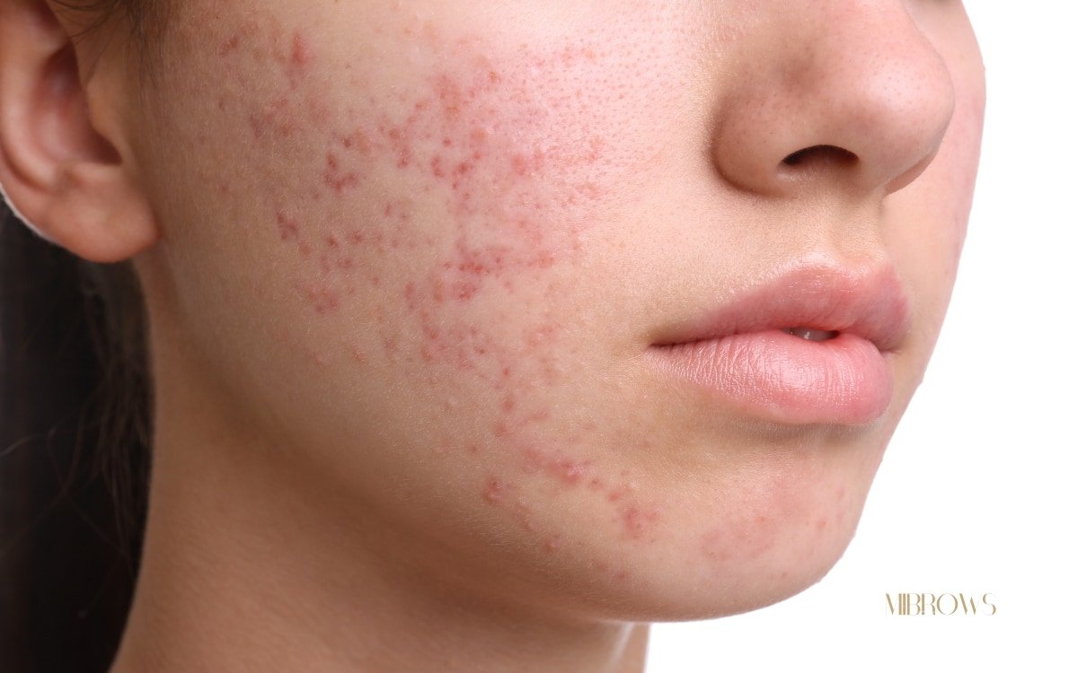 Microneedling-Behandlung-bei-Akne-MIBROWS