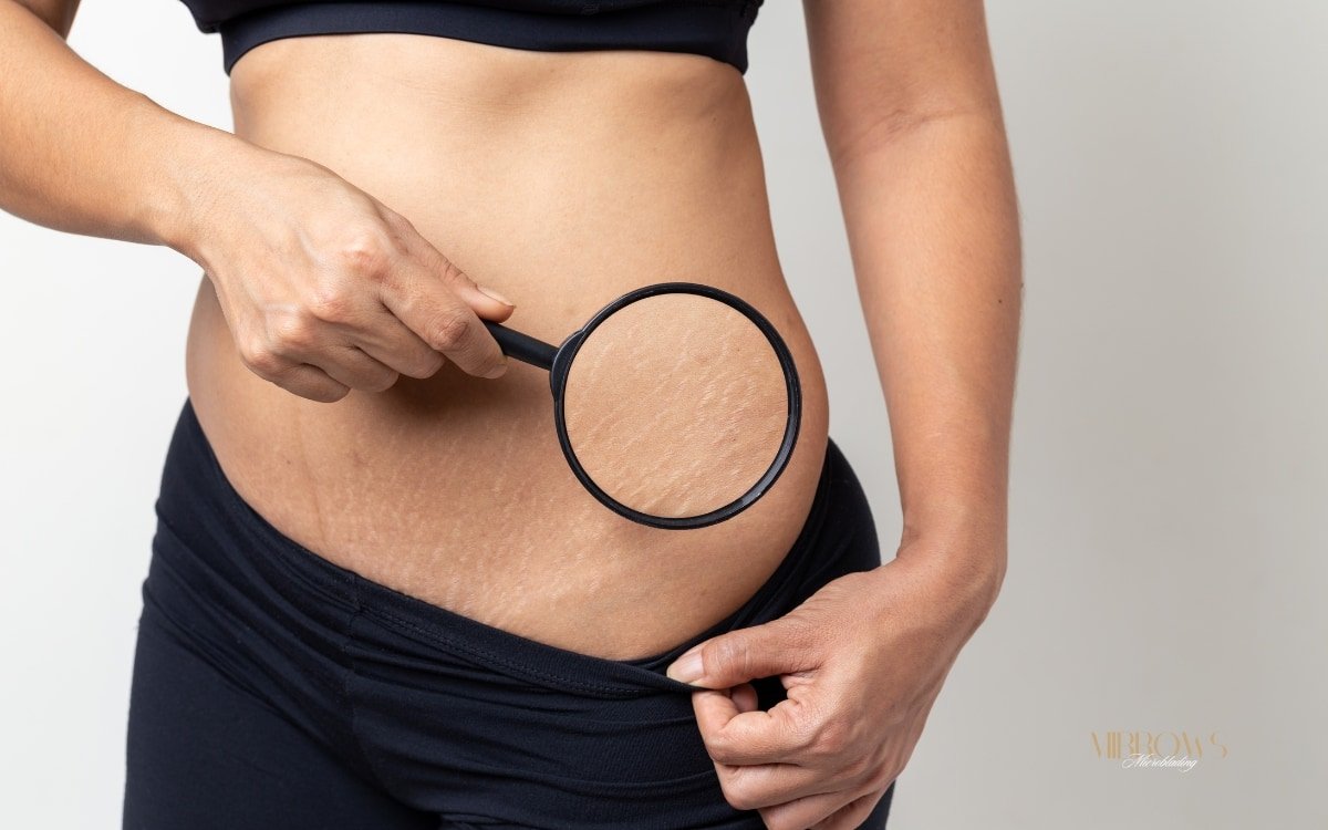 Microneedling Behandlung in Saarbruecken bei Dehnungsstreifen