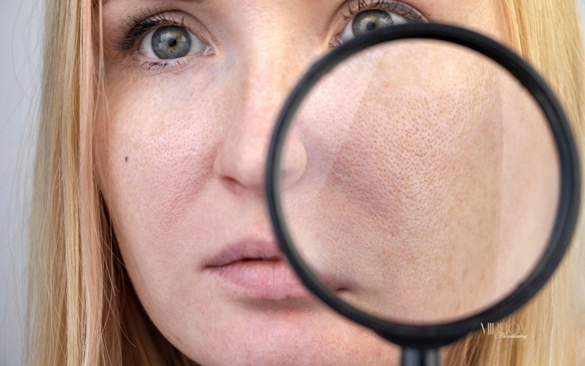 Microneedling Behandlung bei Poren